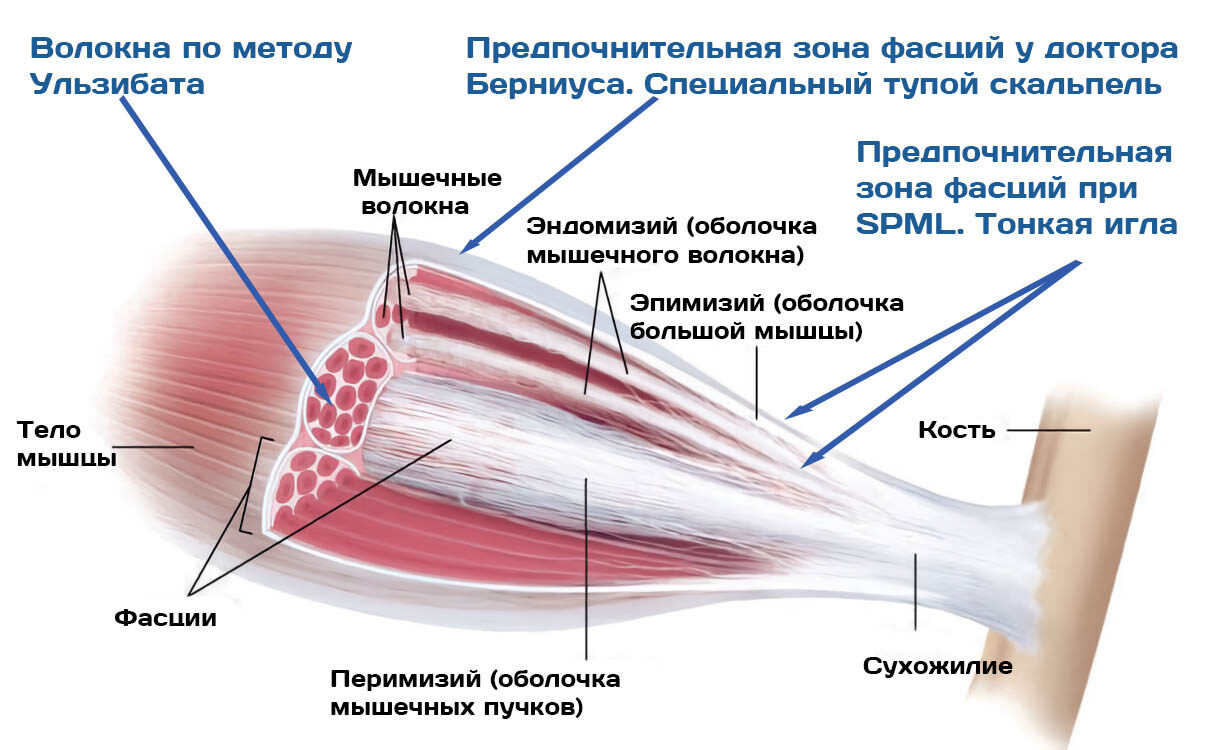 chto-operirujut-pri-spml-ulzibat-bernius-6-1528597-7202449