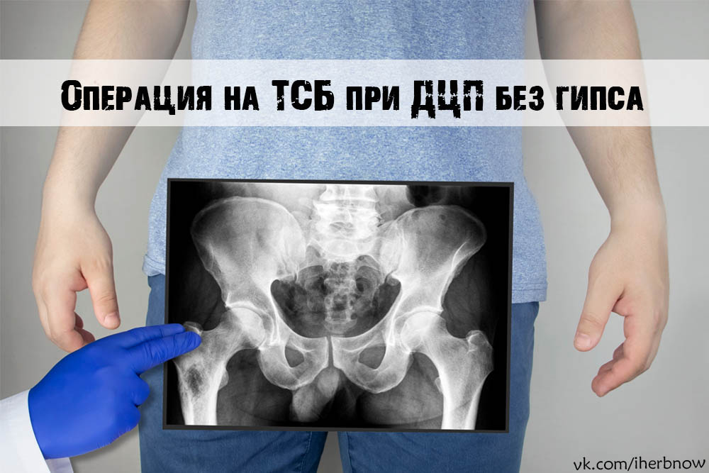 Вы сейчас просматриваете Лечение подвывихов и вывихов при ДЦП без гипса — SLOB