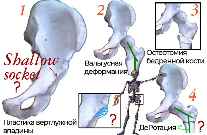 osteotomija-tbs-s-rotaciej-bedrennoj-kosti-kopija-8115779-5268717